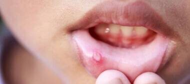 Syphilis (Infection) Treatment in Ashok Nagar | Best Sexologist in Ashok Nagar